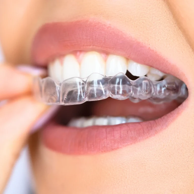Clear Aligners Image description