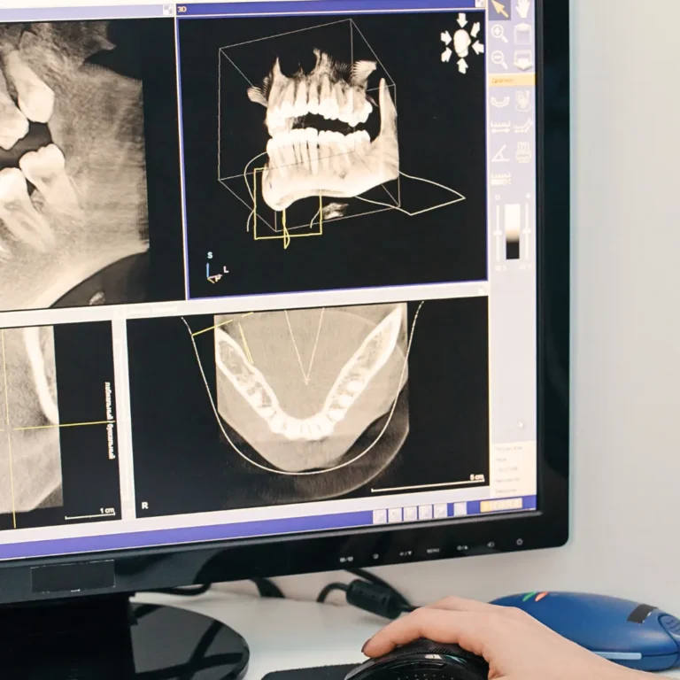 Dental Implants