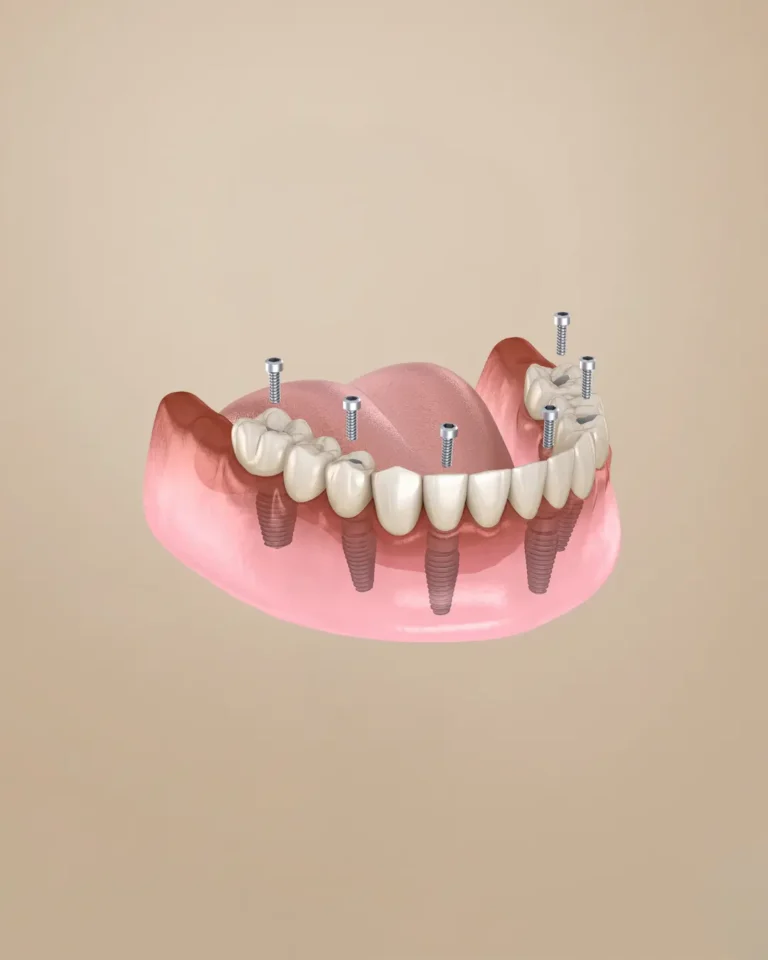 Full Dental Implants Image description