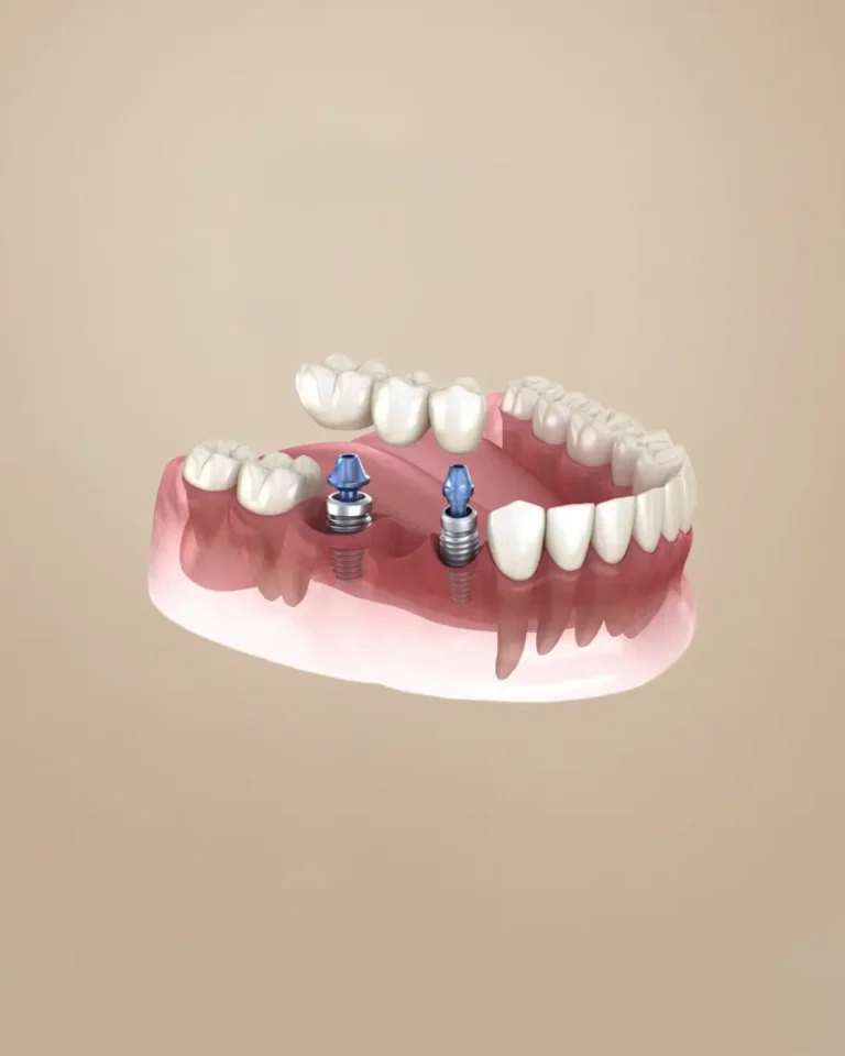 Multiple Dental Implants Image description