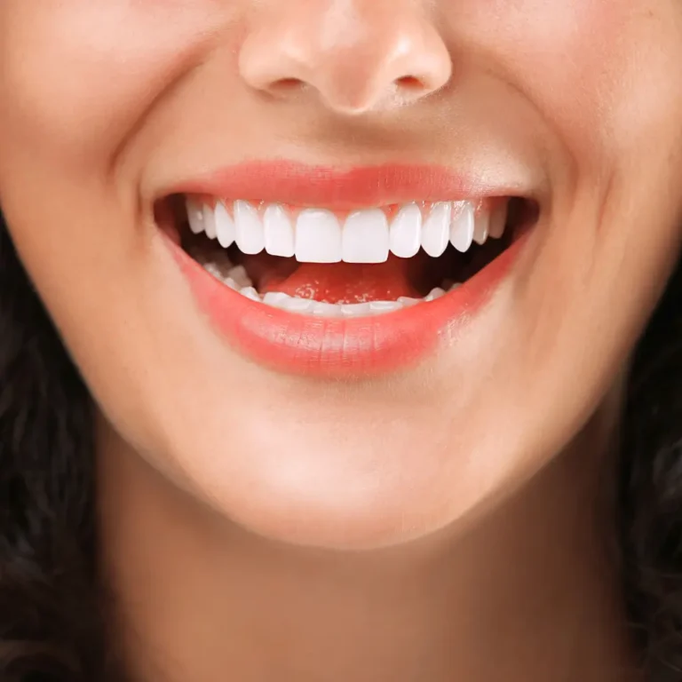 Teeth Whitening